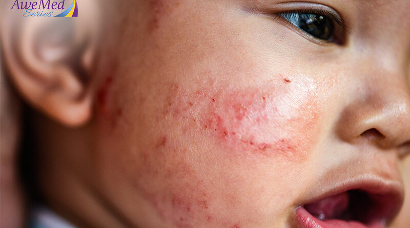 Condition Deep-Dive 5 Common Types of Eczema in Singapore