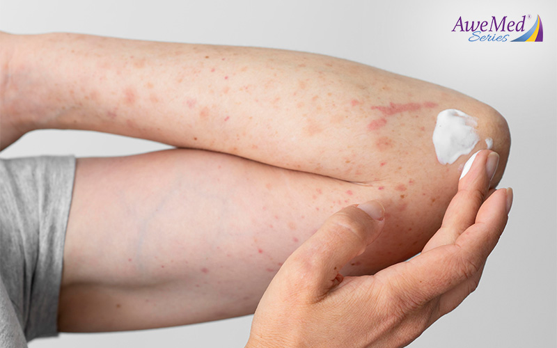 Seborrhoeic Eczema