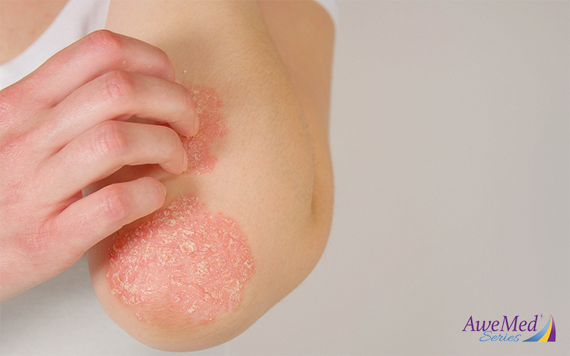 Image of person scratching skin with eczema