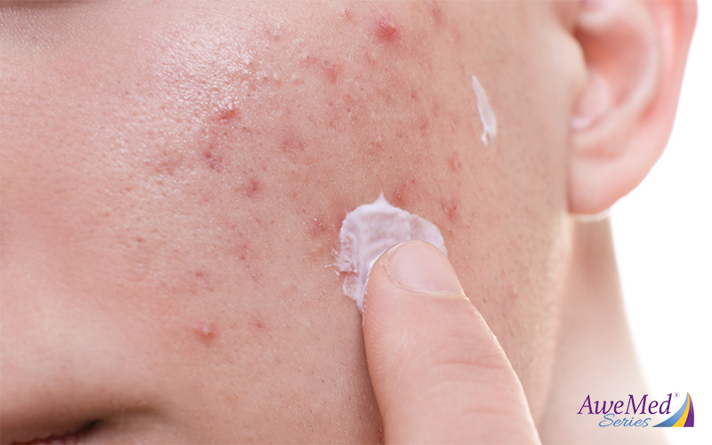 The role of moisturizers in managing eczema