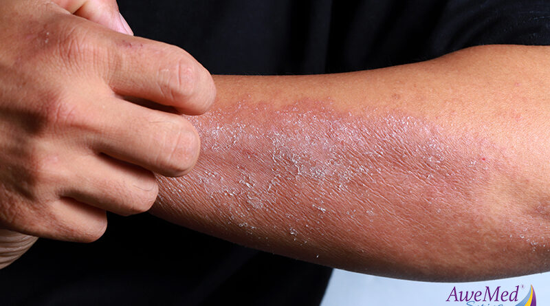 Understanding the Link Between Eczema and Food