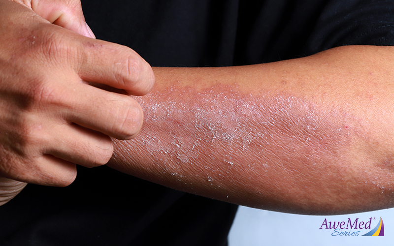 Condition Deep-Dive: Understanding the Link Between Eczema and Food
