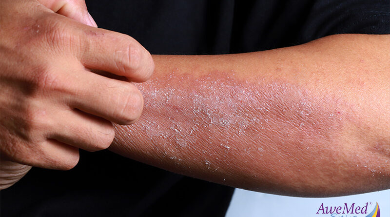 Condition Deep Dive: Eczema Triggers to Avoid