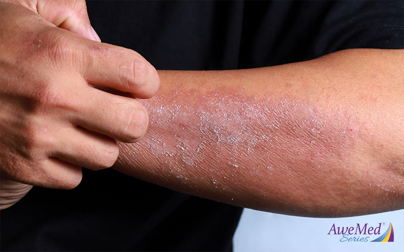 Condition Deep Dive: Eczema Triggers to Avoid