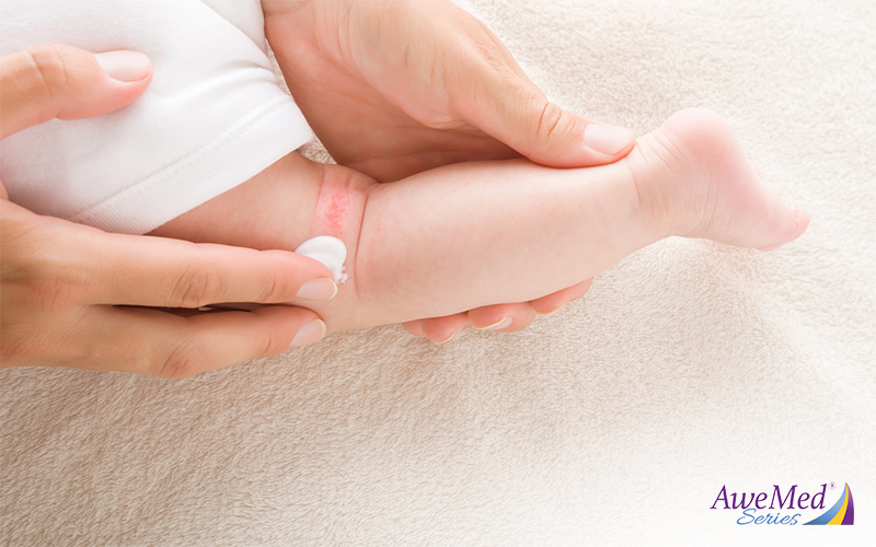 Applying eczema relief cream on baby's leg