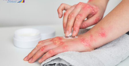 Treating eczema