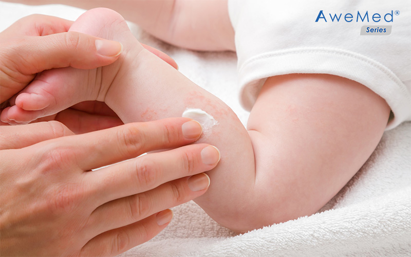 Applying cream on baby eczema skin