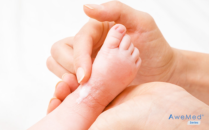 Mother applying eczema solution on child's feet